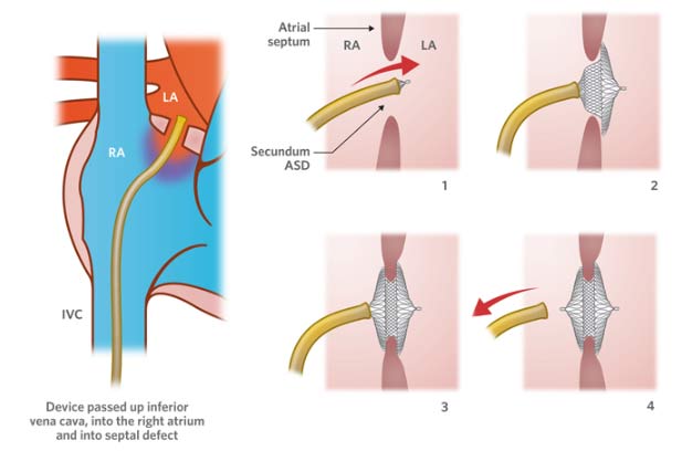 Atrial Septal Defect ASD Closure Newcastle Heart