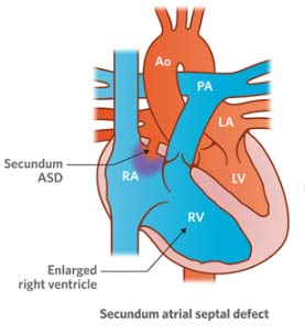 Secundum Atrial Septal Defect Newcastle Heart